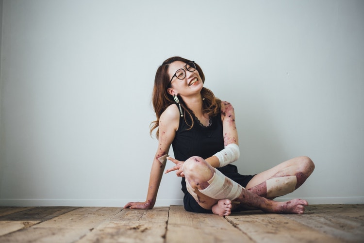 Portrait of a woman with epidermolysis bullosa