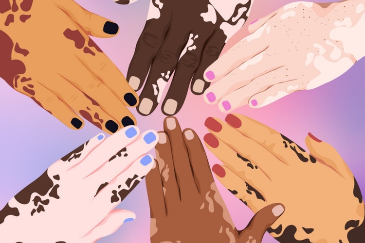 Hands of different ethnicities and skin conditions together